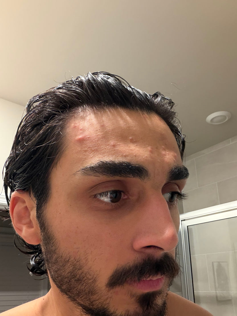 Customer's skin before filtering shower water