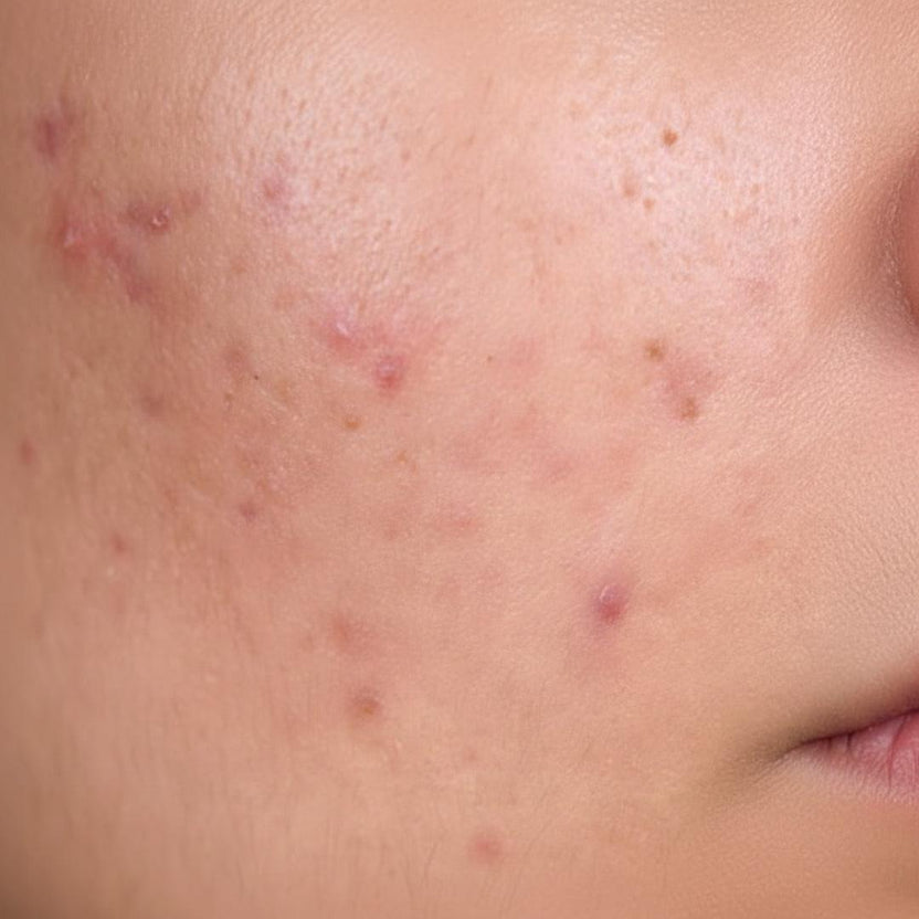 Skin breakouts on a cheek linked to unfiltered shower water